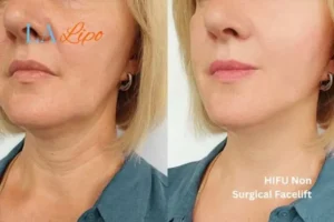 hi-fu for wrinkles Chandler's Ford before and after results