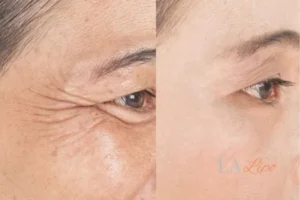 Before and after results of woman - HI-fu wrinkles reduction treatment Chandler's Ford