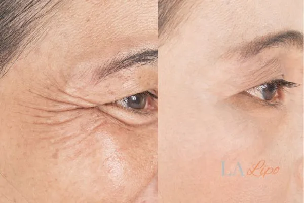 Before and after results of woman - HI-fu wrinkles reduction treatment Chandler's Ford