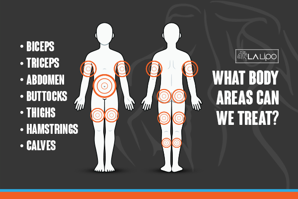 Graphic to show areas you can have LA-EMS Body Sculpting Chandler's Ford treatment.