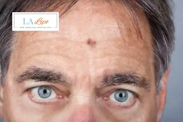 Solar Lentigo Removal Chandler's Ford image of man with mark on his forehead