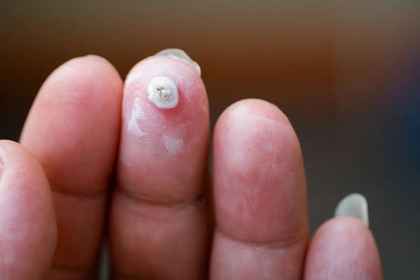 wart on person finger - cryotherapy to treat from LA LIPO Chandler's Ford