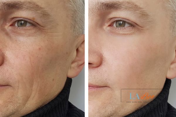 See the amazing results of Morpheus8 Treatment Chandler's Ford!