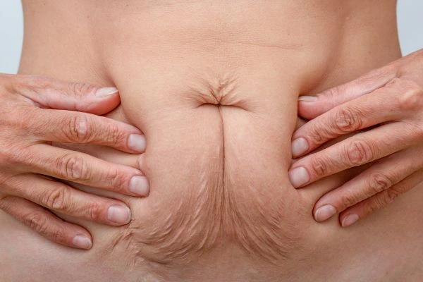 Image of a woman's stomach with loose skin - example of skin tightening Chandler's Ford options