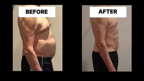 What Symptoms Can Diastasis Recti Cause in Men? Weak Core, Back Pain and Poor Posture Chandler's Ford